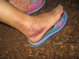 распухшая нога